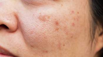 Аллергия на лице: врачи рассказали, как не допустить высыпаний