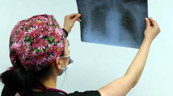 КТ или рентген: врач назвал лучший способ диагностики пневмонии