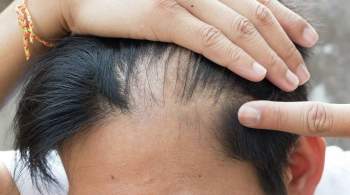 Врач-трихолог рассказала, как остановить выпадение волос после COVID-19