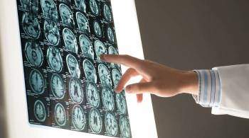 Ученые установили, что COVID-19 может влиять на мозг, как Альцгеймер
